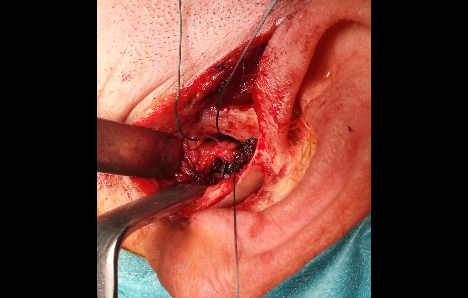 Obr. 8: Provádění diskopexe.