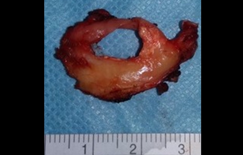 Obr. 9: Odstraněný disk s perforací.