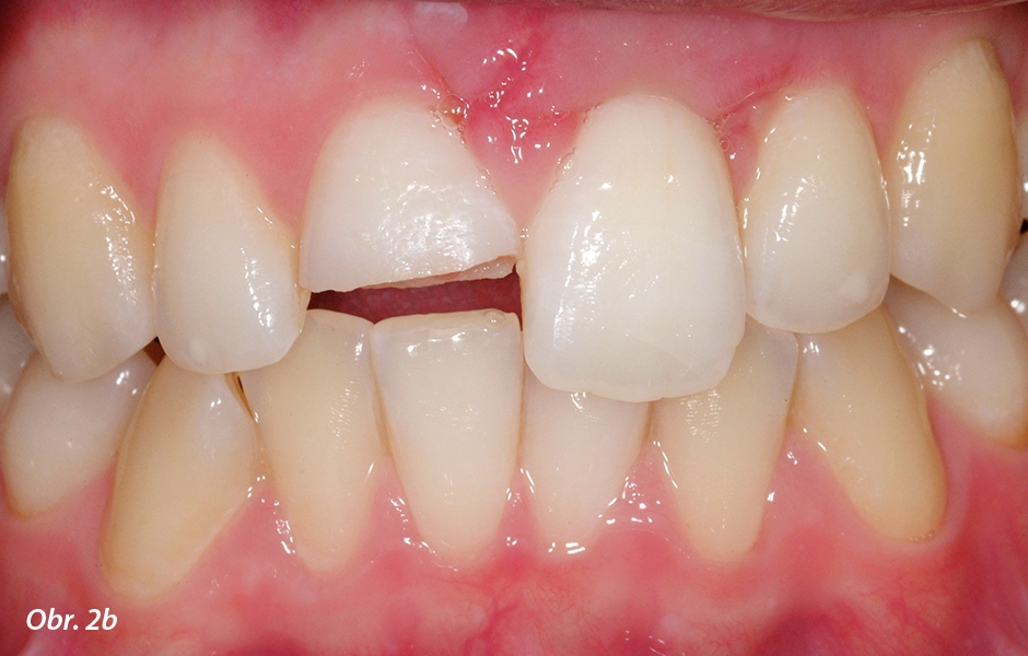 Incizální polovina klinické korunky zubu 11 se horizontálně zlomila.