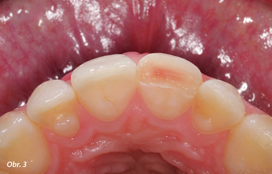 V meziální části lomné linie bylo diagnostikováno obnažení zubní dřeně.