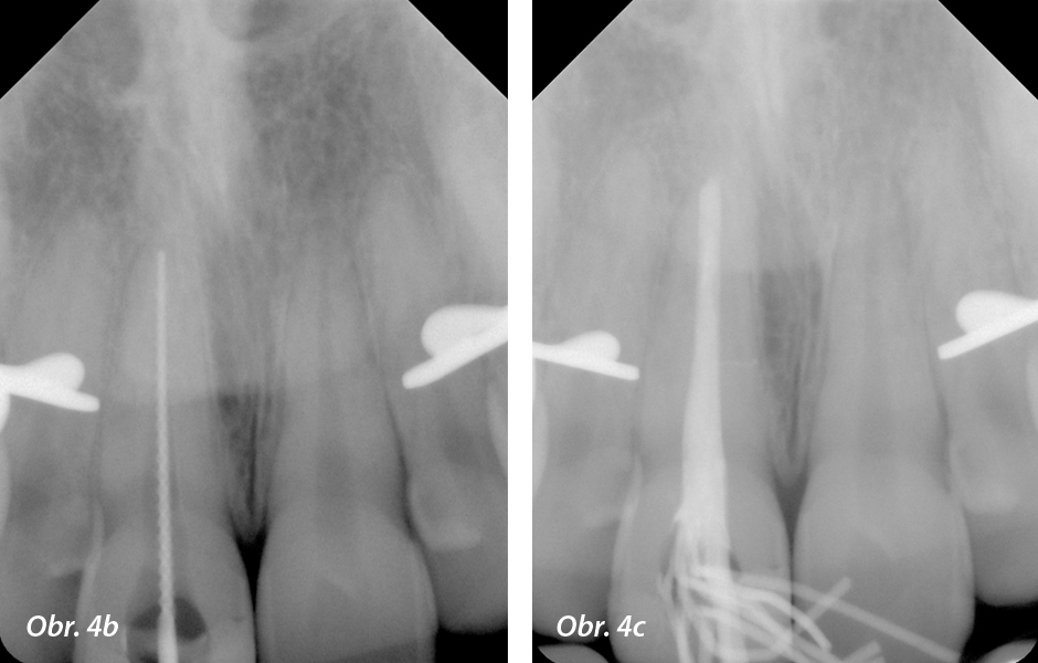 Periapikální rentgenový snímek ke stanovení pracovní délky. Obr. 4c: Kontrolní rentgenový snímek výplně kořenového kanálku technikou laterální kondenzace.
