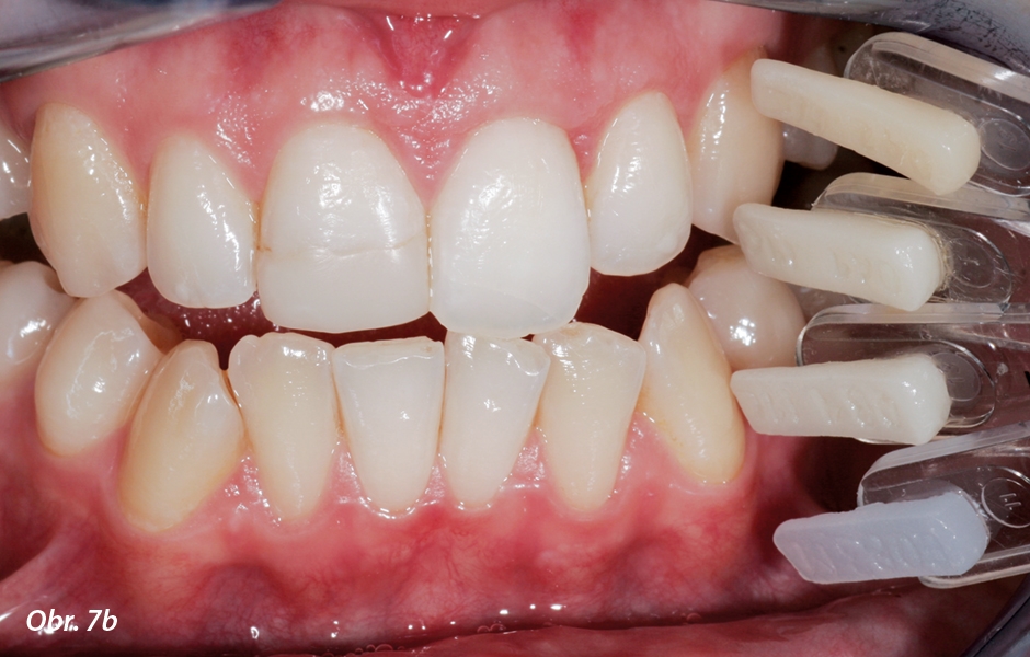 Estetická analýza provedená zubním technikem. Stanovuje se rozložení různých odstínů a průsvitné nebo opakní části zubů v úseku, který má být obnoven.