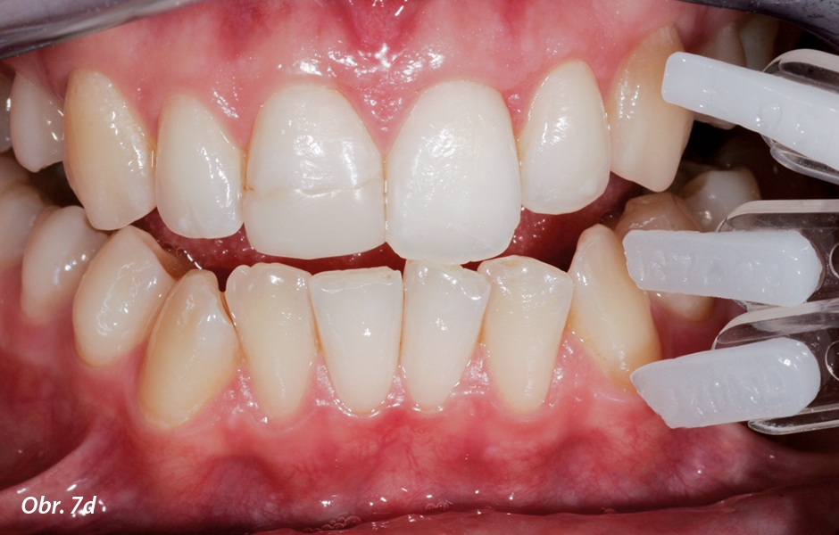 Estetická analýza provedená zubním technikem. Stanovuje se rozložení různých odstínů a průsvitné nebo opakní části zubů v úseku, který má být obnoven.