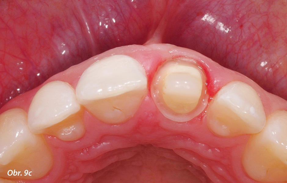 Zub 11 byl preparován pro plnou keramickou korunku s oblým schůdkem po obvodu pahýlu přirozeného zubu.