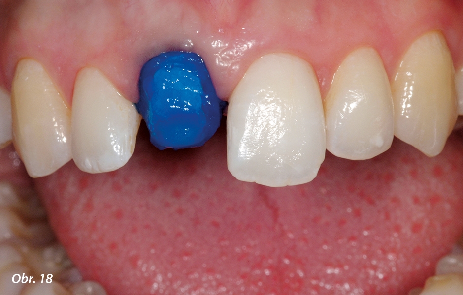 Naleptání povrchu zubu 37% kyselinou fosforečnou.