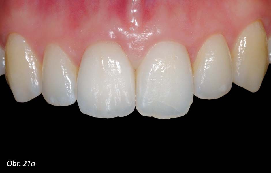 Keramická náhrada vykazuje dokonalé funkční a estetické začlenění mezi okolní zuby.