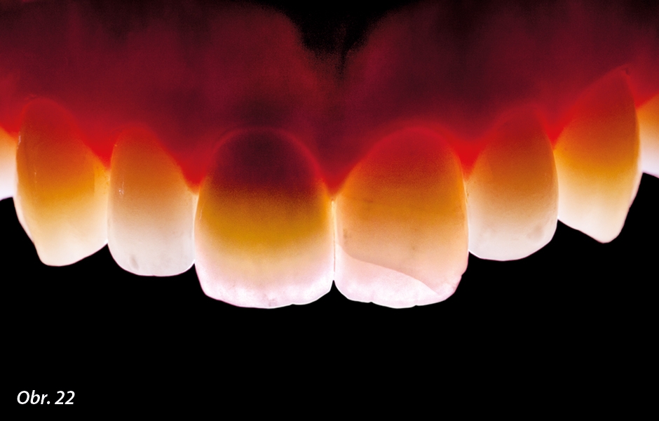 Vynikající propustnost světla činí keramickou korunku k nerozeznání od sousedních zubů v chrupu.