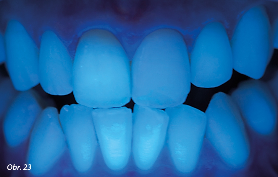 Ultrafialové světlo aktivuje přirozené fluorescenční vlastnosti sklokeramické náhrady, které jsou stejné jako v případě přirozené struktury zubu.