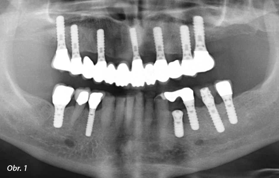 OPG snímek: Pacientka s vícero implantáty v horní i dolní čelisti (rentgenový snímek laskavě poskytnul Dr. M. Gahlert, implantační ordinace, Mnichov).