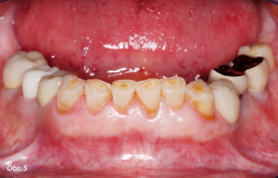 Pacientku obtěžovaly mimo jiné i barva, tvar a velikost dolních frontálních zubů.