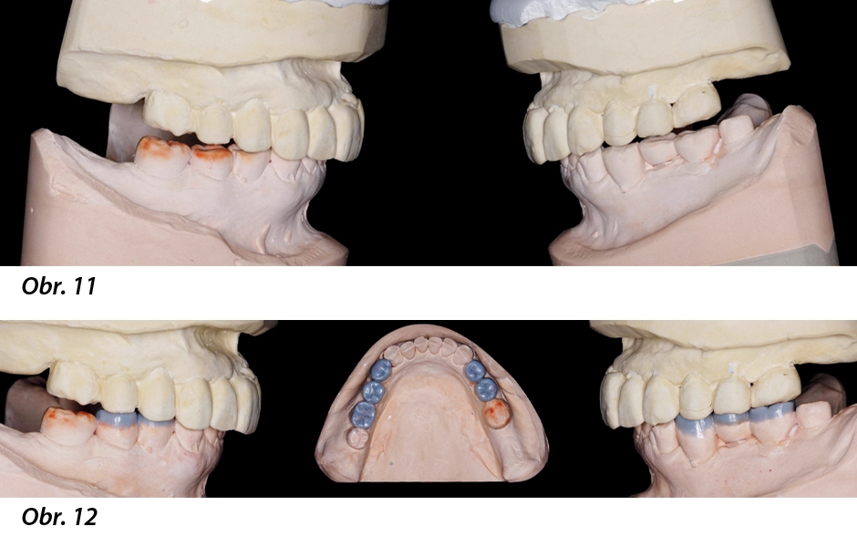 Obr. 11: Model dolní čelisti nově zaartikulovaný pomocí okluzní dlahy nošené šest týdnů. Obr. 12: První fáze wax-upu: Rekonstrukce okluzních částí laterálních zubů vyjma posledních zubů na každé straně.