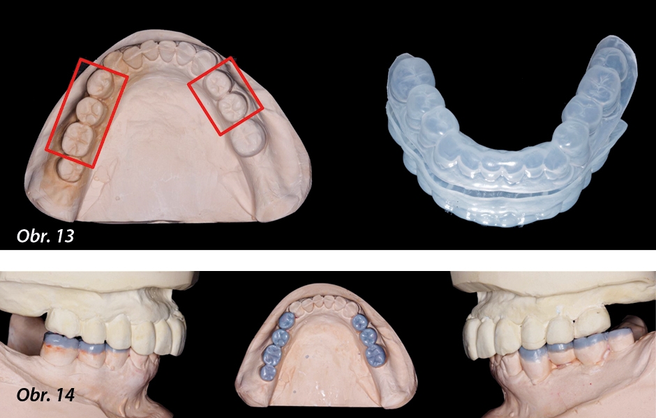 Obr. 13: Zhotovení první dostavbové dlahy (taženou fólií) na sádrovém duplikátu wax-upu.Obr. 14: Druhá fáze wax-upu: Rekonstrukce okluzních částí koncových zubů v laterálních úsecích.