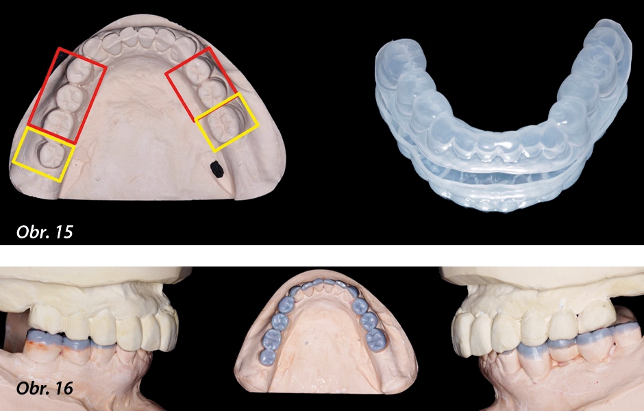 Obr. 15: Zhotovení druhé dostavbové dlahy (taženou fólií) na sádrovém duplikátu wax-upu. Obr. 16: Třetí fáze wax-upu: Rekonstrukce incizních částí dolních frontálních zubů.
