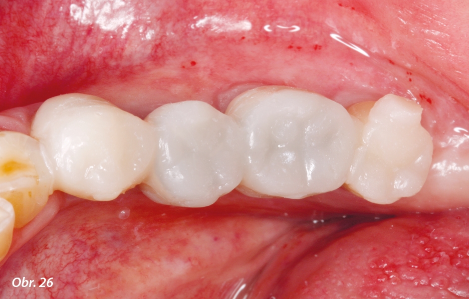 Dostavba okluzních plošek koncových zubů.