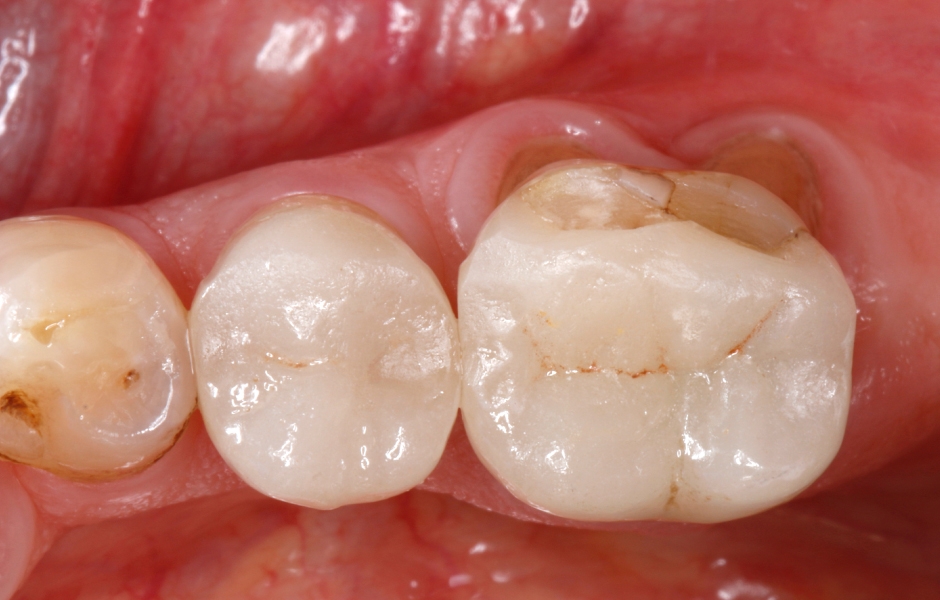 Výchozí situace: Sklokeramická částečná korunka s odlomenou vestibulární ploškou zasahující oba bukální hrbolky zubu.