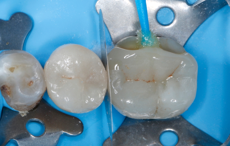 Univerzální adhezivum s reparačními složkami se aplikuje na všechny plochy fraktur, které mají být kondicionovány (keramika, tvrdá zubní hmota) pomocí procesu samoleptání.