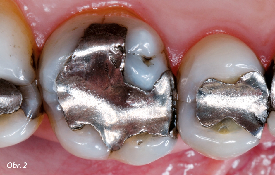 Výchozí situace: stará nevyhovující amalgámová výplň na zubu 16 (foceno přes intraorální zrcadlo)
