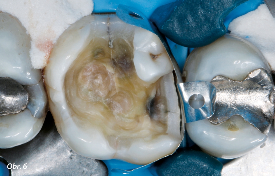 Ohraničení defektu zubu pomocí kovové sekční matrice