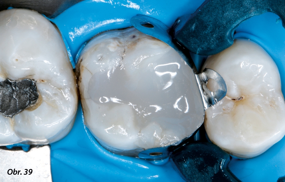 Termoviskózní kompozit chladne během několika málo vteřin po kontaktu se zubem díky odvedení tepla (kondukce) rychle zpět na teplotu dutiny ústní a získává tím zpět svoji vysoce viskózní konzistenci