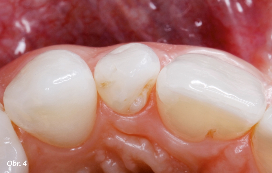 Zub je svou labiální konturou nepatrně mimo zubní oblouk. To vylučuje ošetření pomocí „non-prep“ fazety, které by vyústilo v přílišné překonturování zubu.