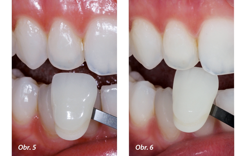 Obr. 5: Stanovení barvy rekonstrukce zubním technikem v laboratoři na kontralaterálním řezáku. Obr. 6: Zhotovením digitální fotografi e s polarizačním filtrem mohou být eliminovány nežádoucí odlesky na zubu
