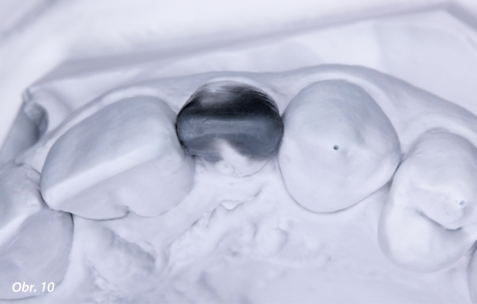 Návrh plánované přestavby postranního řezáku pomoci wax-upu – sádrový model zubu byl za účelem získání prostoru pro wax-up labiálně nepatrně zaradýrován