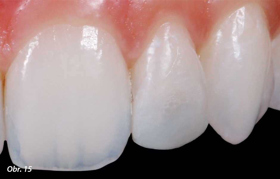 Zkouška mock-upu: plánovaná rekonstrukce tak může být v předstihu vyzkoušena a posouzena ve vztahu k rozměrům, tvaru a postavení v ústech pacienta, aniž by na zubu musela proběhnout nezvratná preparace