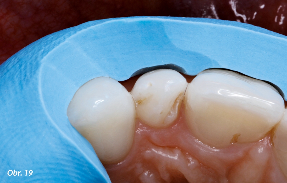 Labiální zbroušení zubních struktur a geometrie preparace je sagitálně i axiálně ověřena pomocí preparačního silikonového klíče