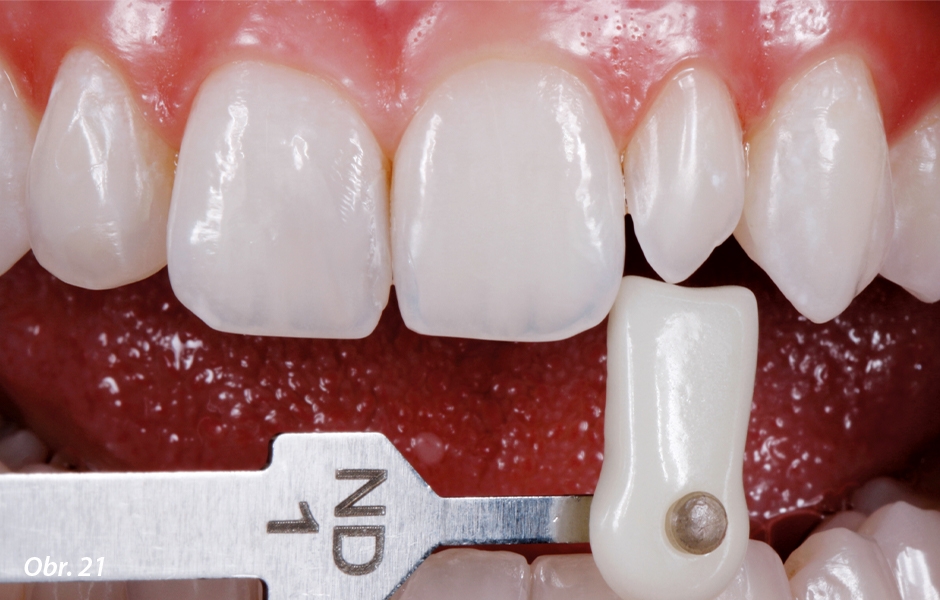 Stanovení barvy preparovaného zubu pomocí speciálního vzorníku