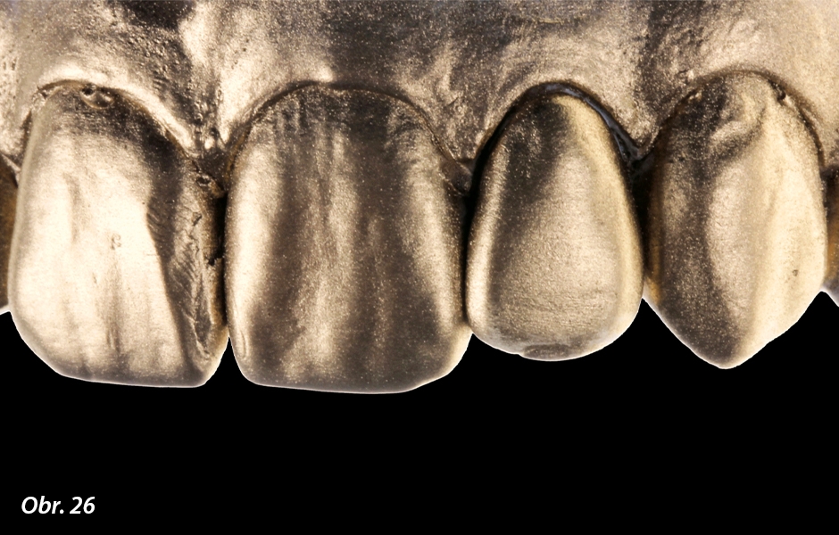 Pomocí zlatého pudru lze kontrolovat povrchovou texturu hotové fazety ve srovnání se sousedními zuby