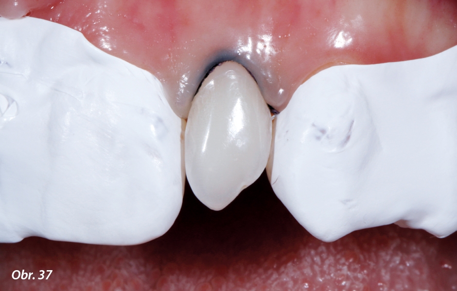 Příprava zubu pro adhezivní fi xaci odtlačením marginální gingivy retrakčním vláknem a izolace sousedních zubů teflonovou páskou