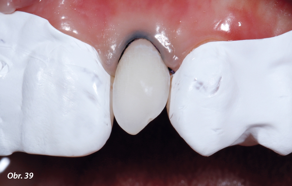 Po opláchnutí kyseliny a osušení zubu je patrný „mrazivý“ vzhled povrchu preparace zcela ohraničené sklovinou
