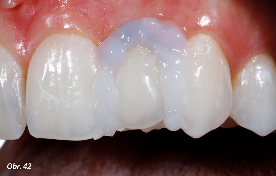 Keramickou fazetu nasadíme na zubní pahýl společně s fixačním kompozitem. Po odstranění přebytků adheziva překryjeme fixační spáru glycerinovým gelem k zamezení tvorby povrchové inhibiční vrstvy na povrchu fixačního kompozitu