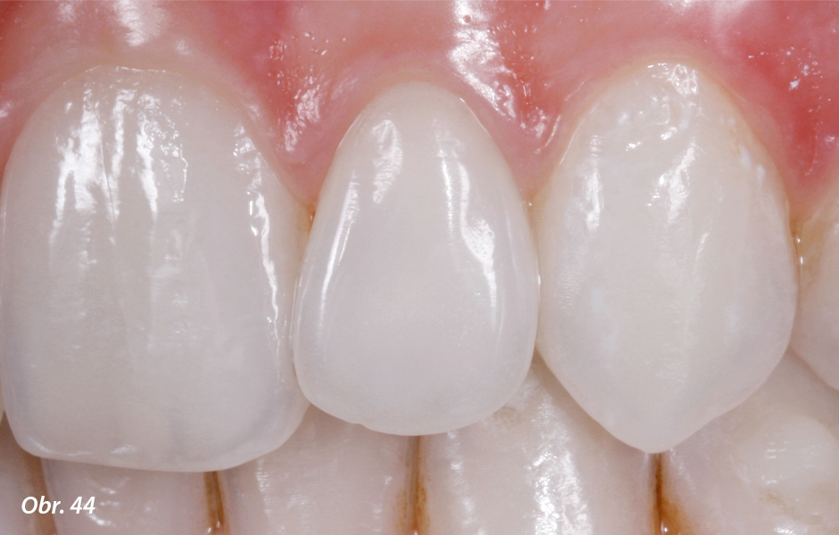 Výslednou remodelaci čípkovitého levého postranního řezáku do odpovídajícího tvaru pomocí fazety lze považovat za optimální. Fazeta vykazuje velmi dobrou funkční a estetickou integraci do stávajícího zubního oblouku.