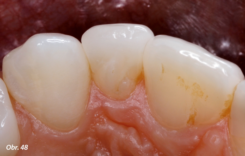 V incizálním pohledu je patrné vyrovnání palatinální anatomie čípkovitého zubu pomocí keramiky. Tím je současně optimalizováno i řezákové vedení v dynamické okluzi.
