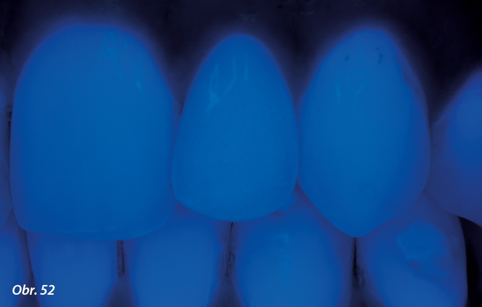 Rovněž fluorescenční vlastnosti, ověřené UV světlem, neumožňují rozeznat jakékoli rozdíly mezi keramickou rekonstrukcí a vlastními přirozenými zuby