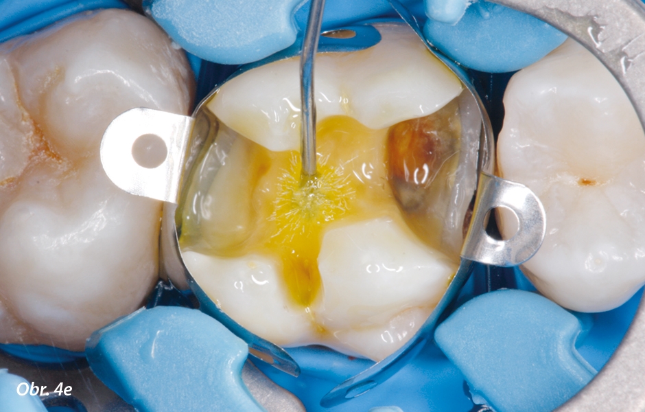 Adhezivní příprava tvrdých zubních tkání.