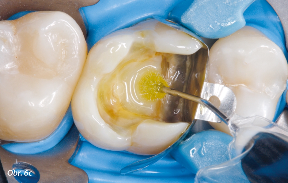 Po exkavaci a preparaci kavity byl nasazen kofferdam a matricový systém. Poté následovala adhezivní příprava tvrdých zubních tkání.