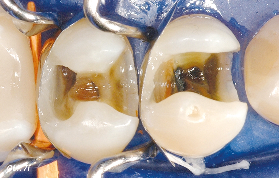 Na obou zubech současně byly u každého z nich z jedné dávky kompozitu dostavěny celé distální aproximální stěny – od samotného dna kavity až do výšky okrajové lišty.