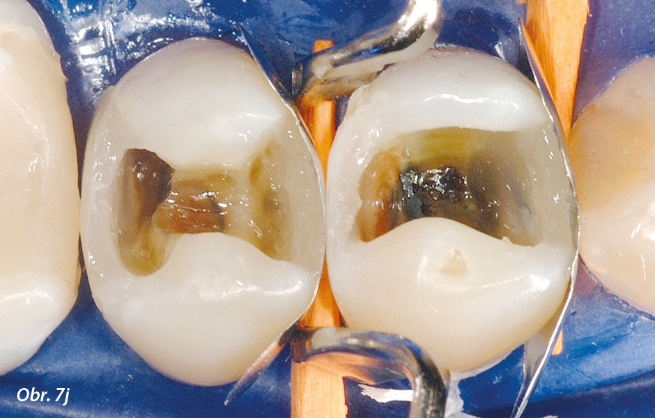 Na obou zubech současně byly u každého z jedné dávky kompozitu dostavěny i celé meziální aproximální stěny – od samotného dna kavity až do výšky okrajové lišty.