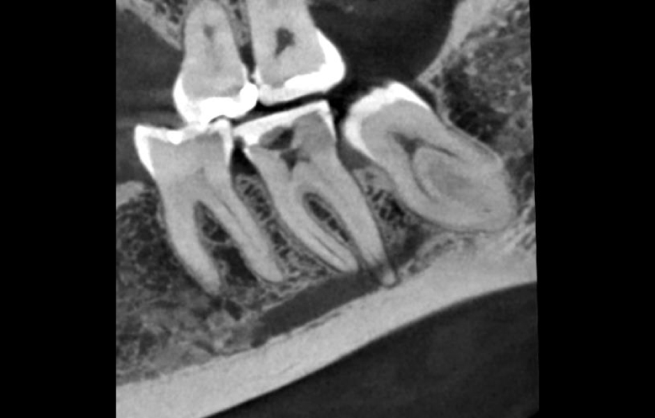 Obr. 1: Úzce fokusovaný CBCT sken s vysokým rozlišením zobrazuje distální levou část mandibuly.