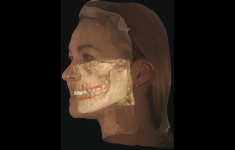 Obr. 10: Propojení skenu obličeje, skeletu a digitálního otisku představuje nejen sofistikovanou diagnostickou a plánovací technologii, ale také názornou edukační pomůcku pro pacienta.