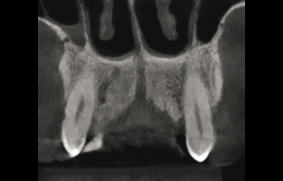 Obr. 3: Koronární řez frontální částí maxily ukazuje přítomnost esovitě zahnutého canalis sinuosus (vpravo).
