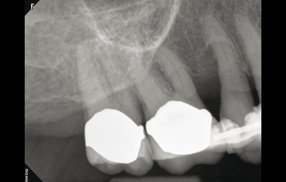 Obr. 4: Periapikální RVG laterálního úseku maxily (vpravo).