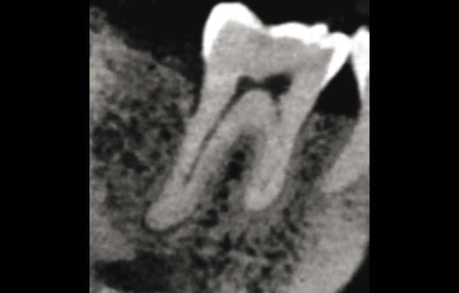 Obr. 7: Stejný zub jako na obr. 6: sagitální řez ukazuje lokalizovanou ztrátu kosti na distální ploše kořene.