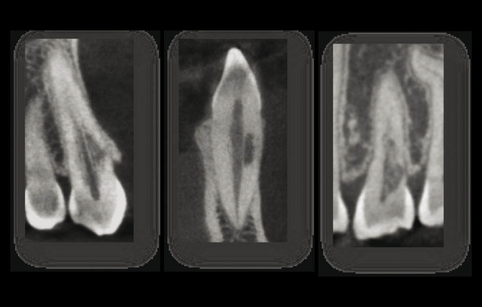 Obr. 8a–c: Na tenkých CBCT sekvencích je patrný rozsah a lokalizace cervikální resorpce v rozsahu třetiny kořene.