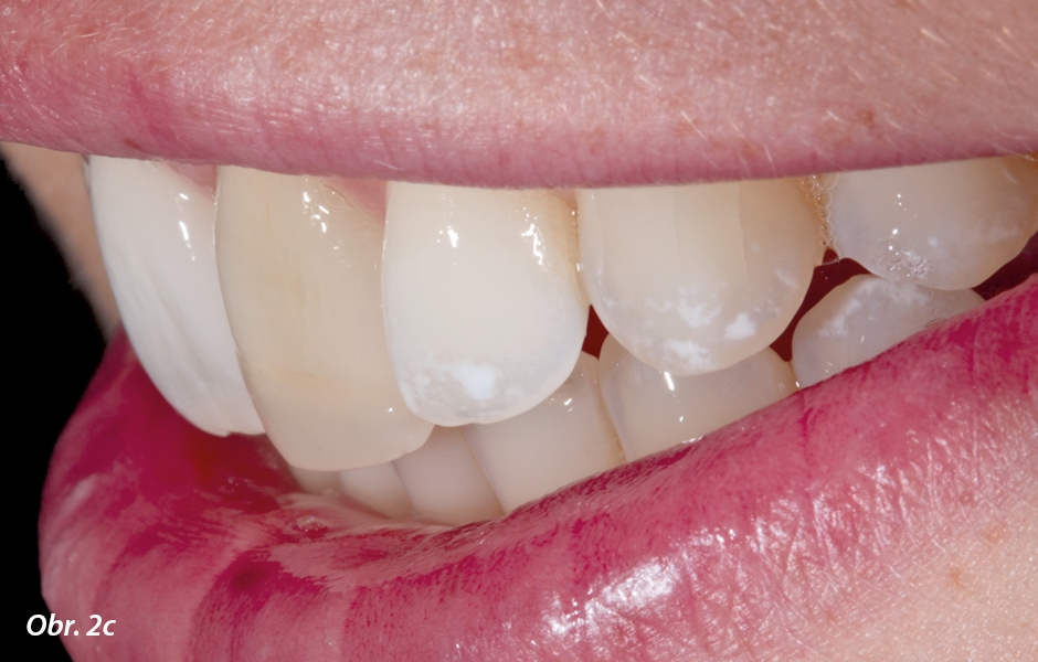 Iniciální situace: estetické poškození diskolorací zubu