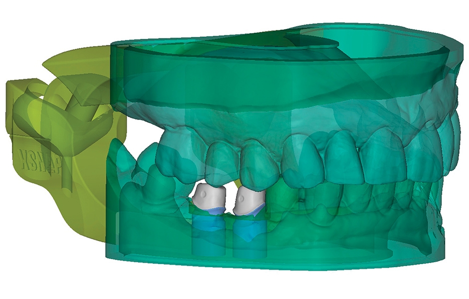 Obr. 4a: CAD návrh hlavního pracovního modelu s integrovanou duální artikulací umožňující individuální žvýkací pohyby (xSNAP 360, xWERK GmbH, Dachau/D).