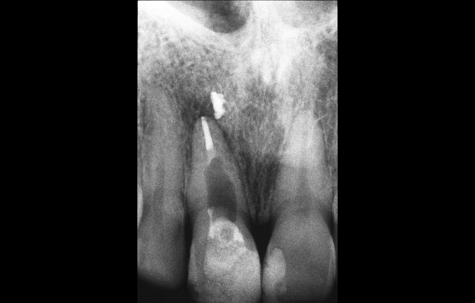 Obr. 1.1: Předoperační rentgenový snímek horního pravého středního řezáku.