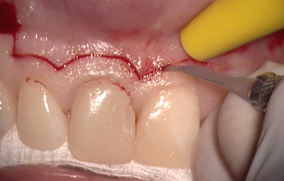 Obr. 1.2: Submarginální incize.